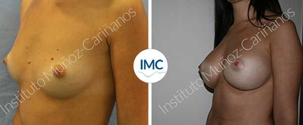 Implantes de pecho